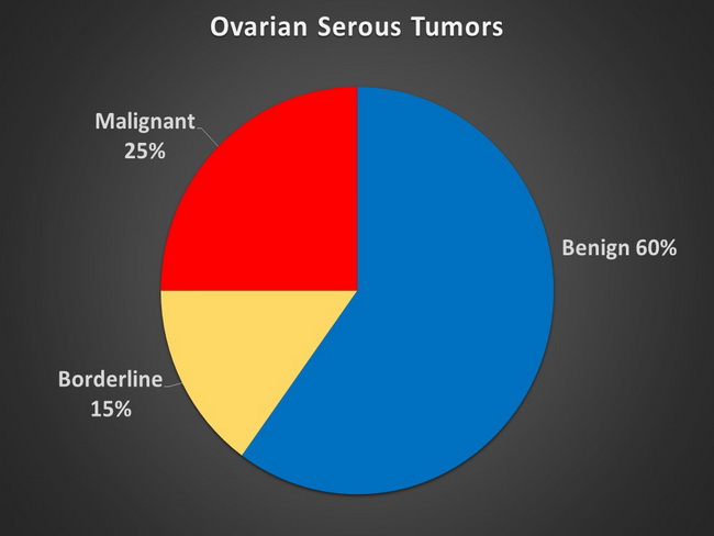 OvarianCancer_Serous Tumors_resized.jpg
